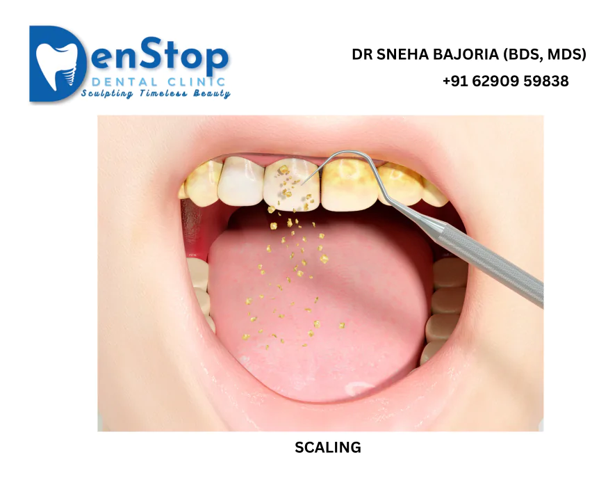 scaling at denstop bhawanipore kolkata