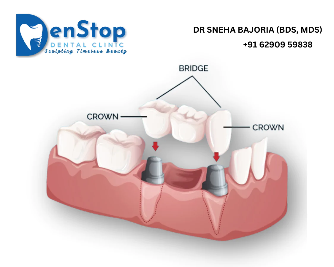 crown at dental clinic kolkata