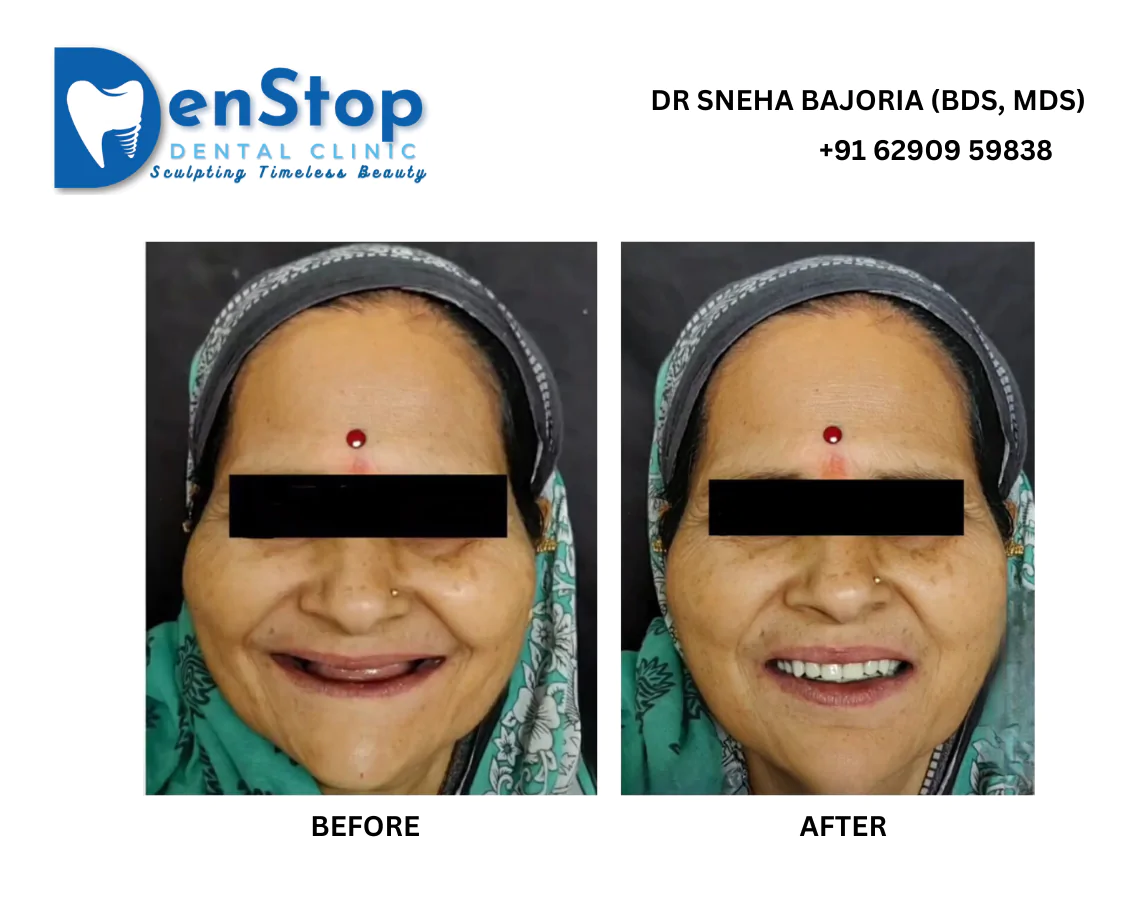 Implant by sneha bajoria at denstop dental clinic bhawanipore