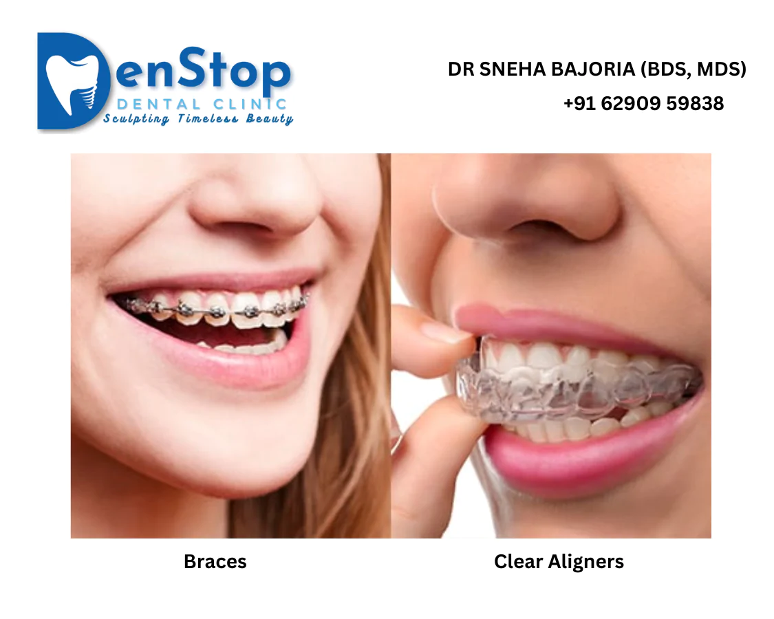 best aligners by dental kolkata