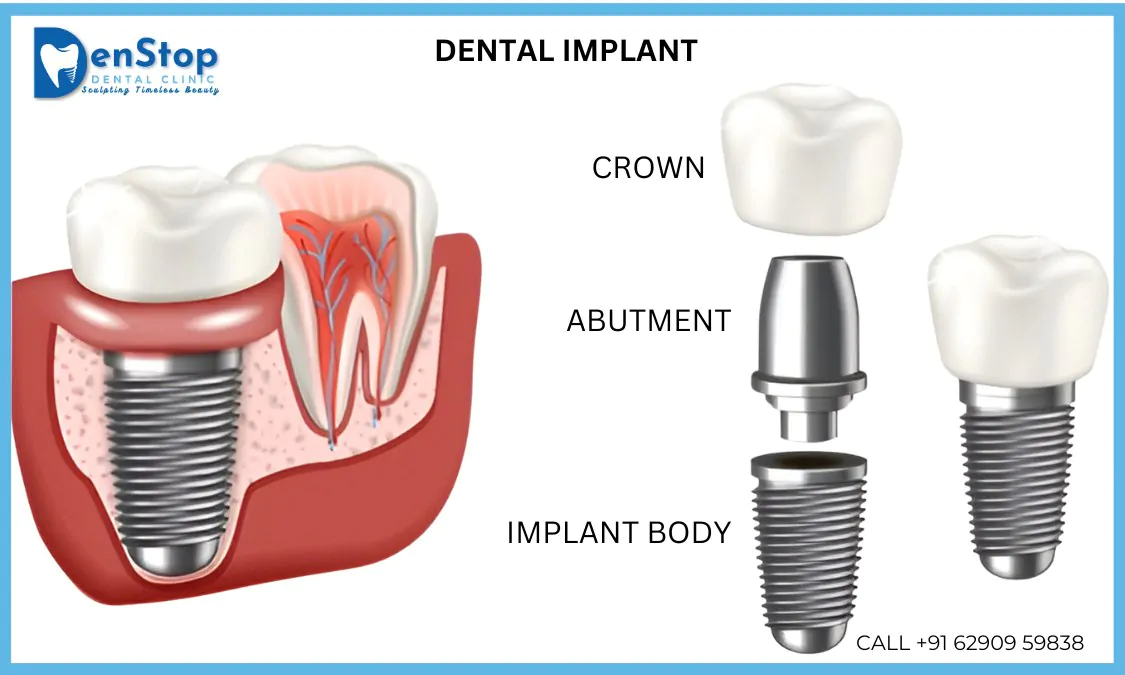 dental implant at bhawanipore kolkata