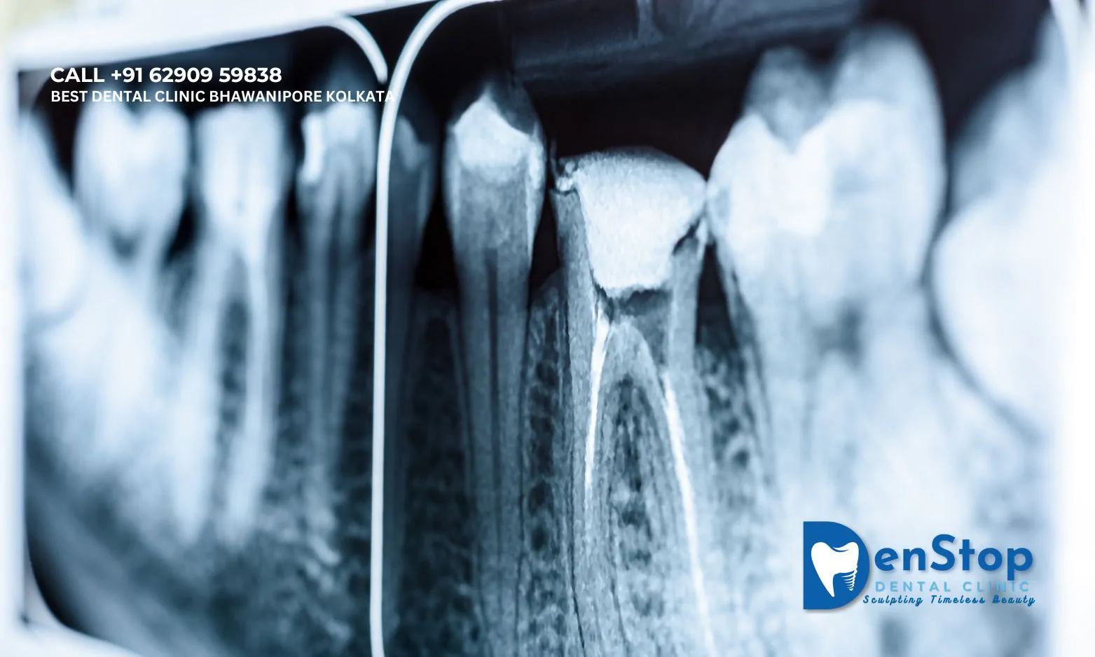 Unveiling the Mystery: A Comprehensive Guide to Root Canals at Denstop Dental Clinic, Bhawanipur