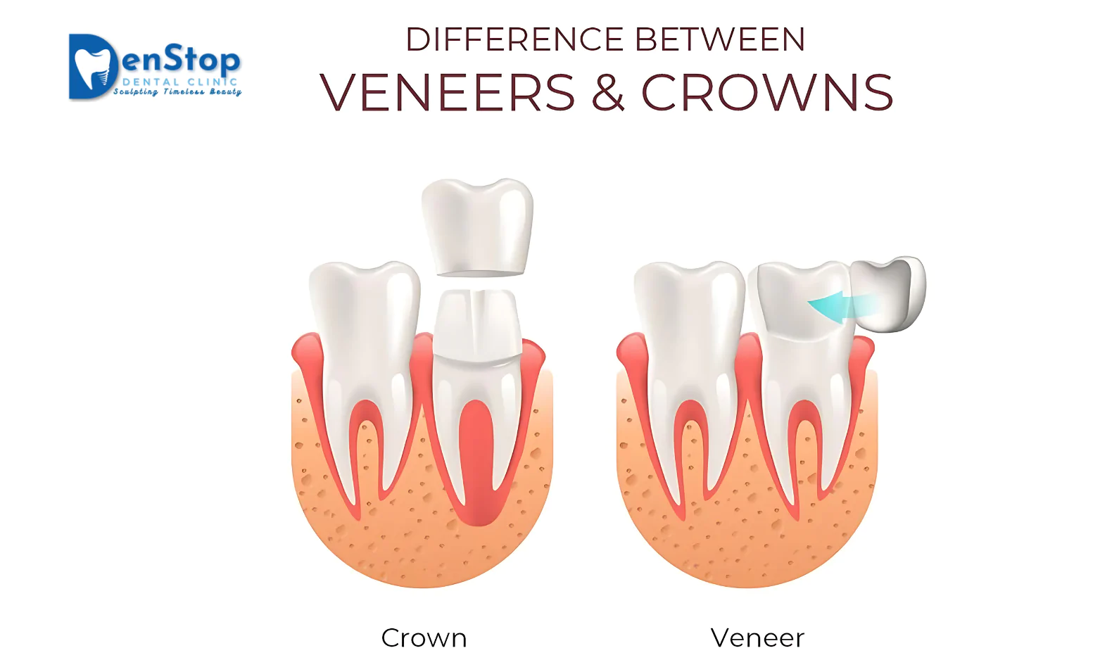 Unveiling the Mystery: Veneers vs. Crowns – A Dentist’s Guide to a Perfect Smile